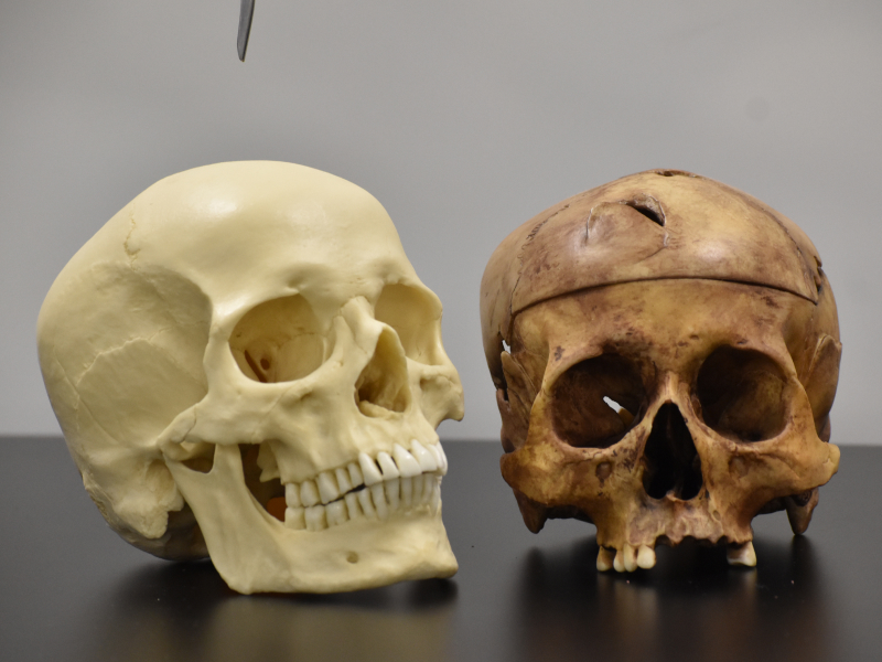 Two skulls for medical studies, one with teeth missing, sitting on a counter.